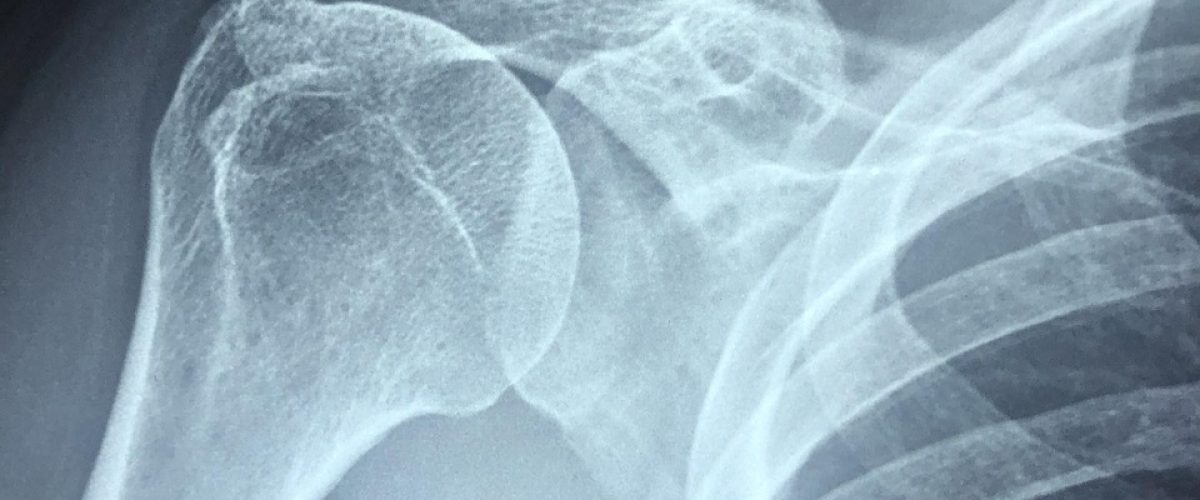 arm, healthy, rotator cuff, pain, x-rays, shoulder, body, bones, medicine, illness, patient, blue pain, blue healthy, blue medicine, blue body